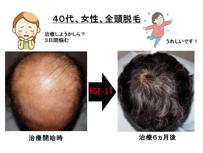 円形脱毛症　病院
